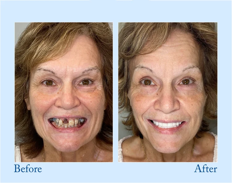 Vollprothese for Naturligt Smil – Smileasego
